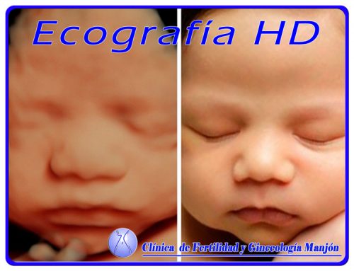 ecografia HD